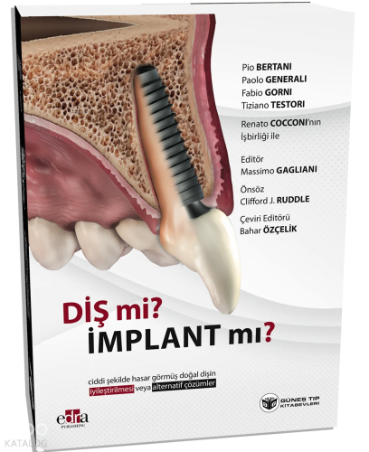 Diş mi? İmplant mı? Doğal Dişin Korunması veya İmplant Çözümleri Üzerine Kapsamlı Rehber