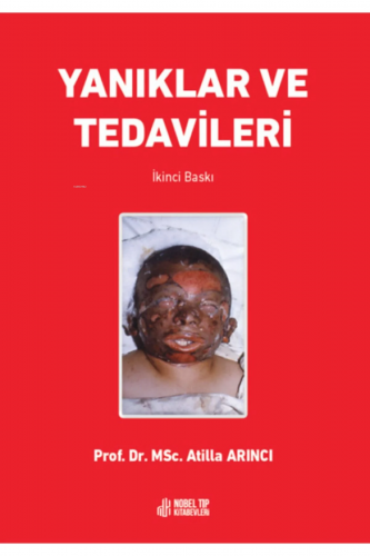 Yanıklar Ve Tedavileri